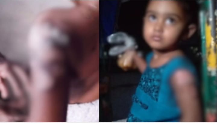 শ্রীপুরে ৪ বছরের শিশুকে গরম চাকুর ছ্যাঁকা দিল সৎ বাবা নামের জানোয়ার।