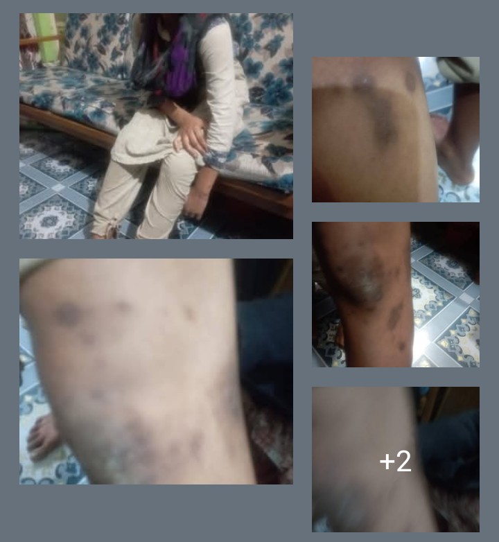 ব্রাহ্মণবাড়িয়ায় ডাক্তার দম্পতির নির্মম নির্যাতনের শিকার আয়েশা নামের এক কিশোরী।